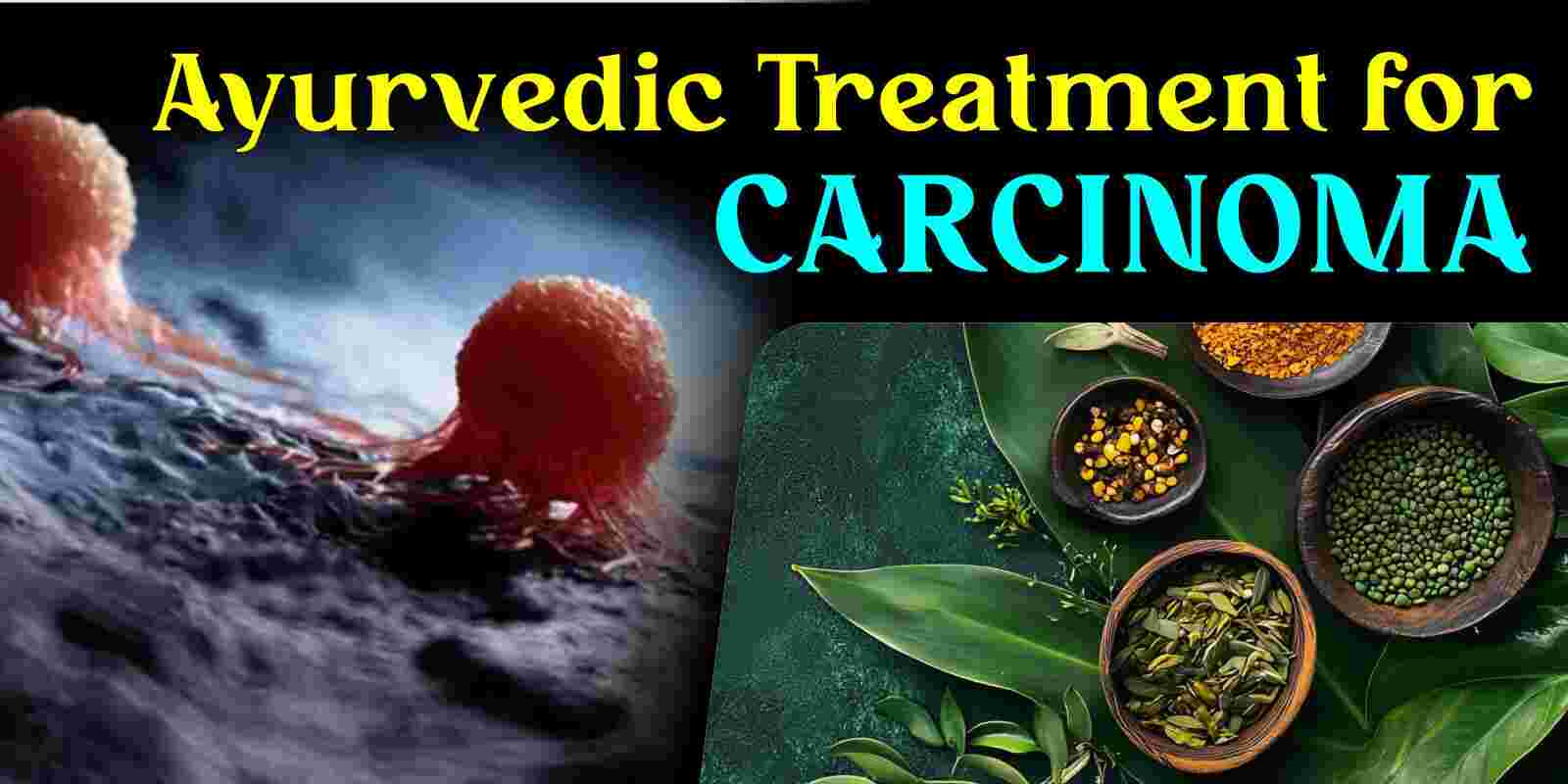 Ayurvedic Treatment for Carcinoma